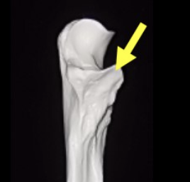 <p>Coronoid process (ulna proximal end)</p>