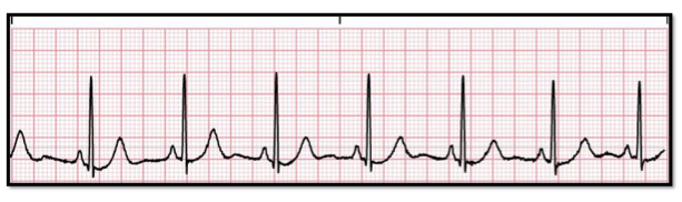 <p>Identify:<br>a. normal sinus rhythm<br>b. sinus bradycardia<br>c. 1st degree heart block<br>d. sinus tachycadia </p>