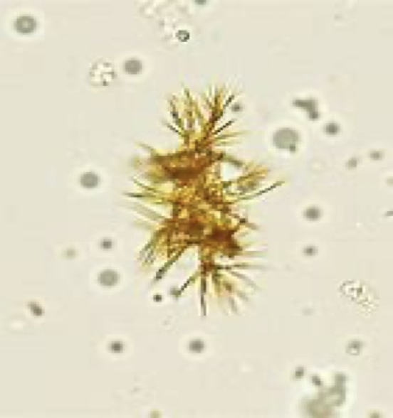 <ul><li><p>Typically seen in acidic urine</p></li><li><p>Appear as rhomboid plates, needles, or granules and are yellow, ruby red, or dark brown in color.</p></li><li><p>Commonly seen in conjunction with bilirubinuria and have little to no additional significance.</p></li></ul><p></p>