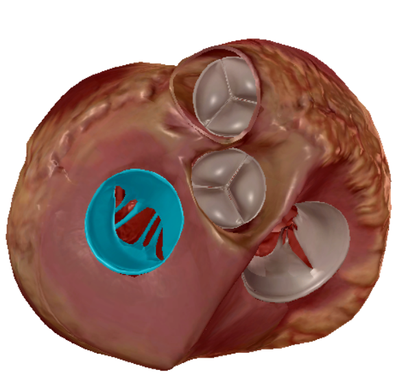<p>left atrium to left ventricle</p>
