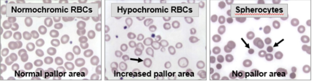 <ul><li><p><span style="background-color: transparent;">Normal Hgb concentration (32.0 – 36.0%): normochromic red cells</span></p></li><li><p><span style="background-color: transparent;">Low Hgb concentration (MCHC <32.0%): hypochromic red cells with increased pallor area</span></p></li><li><p><span style="background-color: transparent;">High Hgb concentration (>36.0%): red cells are spherocytes with no pallor area → NOT HYPERCHROMIC</span></p></li></ul><p></p>