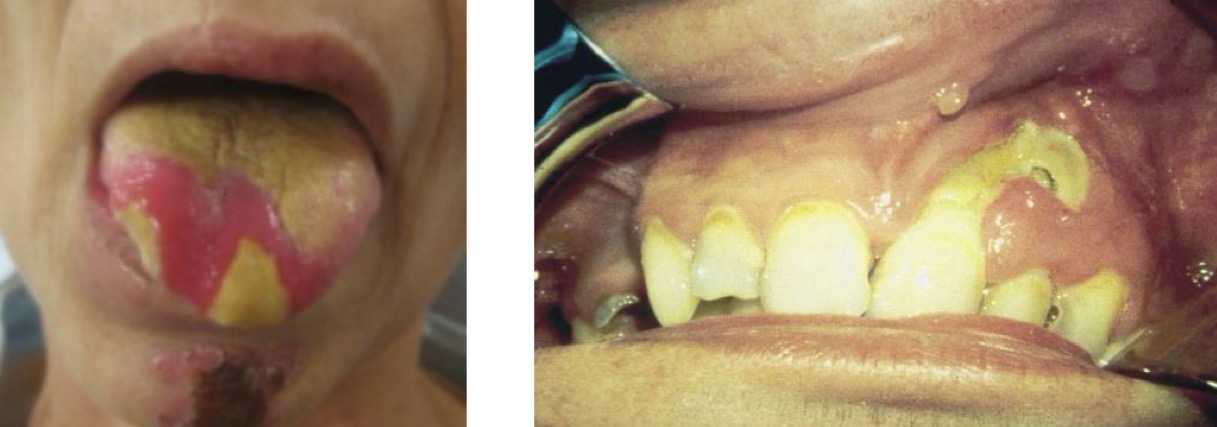 <p>PD</p><p>Gingival lesions</p><p>Gingival recession </p>
