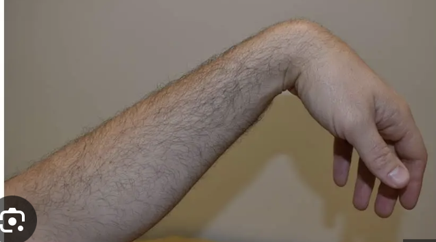 <p>wrist drop (radial nerve palsy)</p>