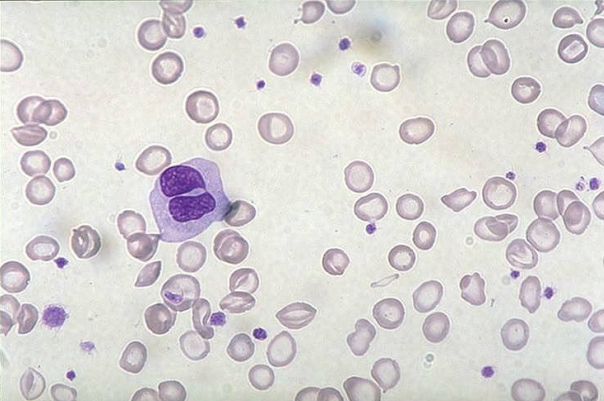 <p>what would the RBC morphology look like in those with iron-deficiency anemia? <strong>(learning objective)</strong></p>