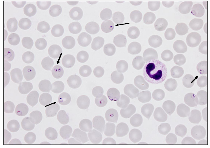 <p>- Malaria (Plasmodium falciparum)</p><p>- Parasites inside RBC burst releasing Hb and dark urine</p>