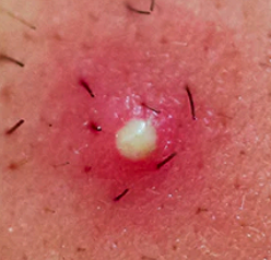 <p><span>pustules</span></p>