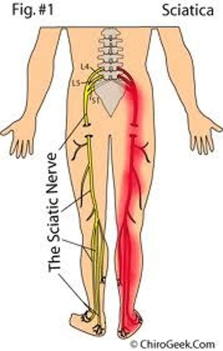<p>Inflammation of the sciatic nerve, unilateral pain.</p>