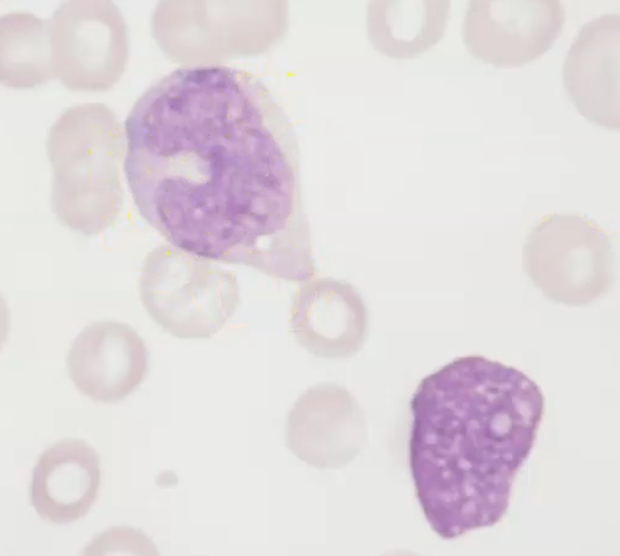 <p>myelomonocytic - monoblast </p>