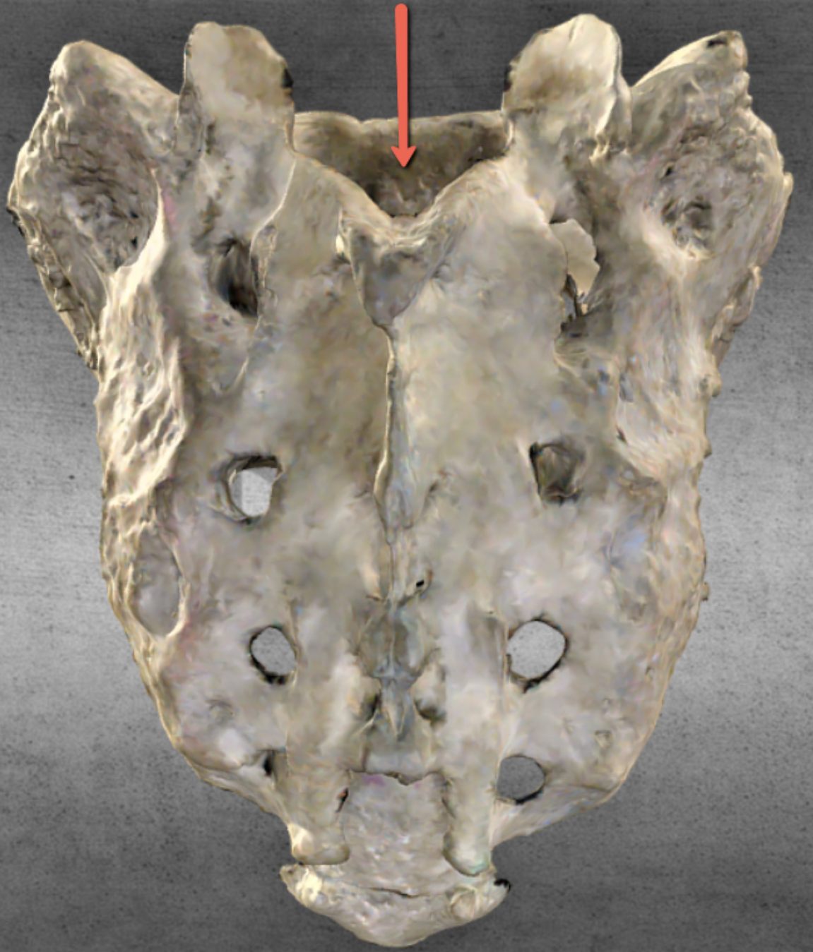 <p><span><strong>Identify the bone marking indicated by the pointer.</strong></span></p>