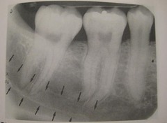 <p>Radiolucent band with radiopaque borders below mandibular molars</p>