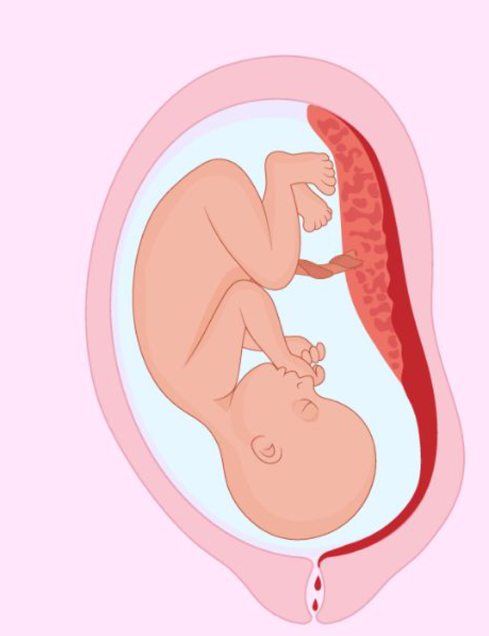 <p>placental abruption</p>