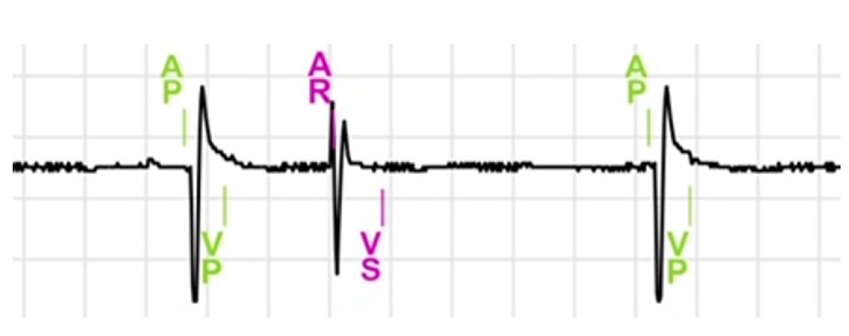 <p>This interval is triggered by a ventricular sensed (VS) or ventricular paced (VP) event</p><p>At times, premature atrial contractions (PACs) or retrograde P-waves occur on the atrial channel. The PVARP interval is designed to avoid tracking PACs or retrograde P-waves</p>
