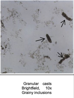 <p>Granular cast (coarse)</p>