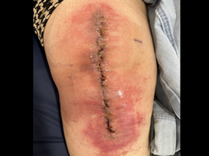 <ul><li><p>Patient’s normal flora</p><ul><li><p>Staphylococcus aureus</p></li><li><p>Escherichia coli</p></li></ul></li><li><p>Fever, pus, redness at surgery site</p></li></ul><p></p>