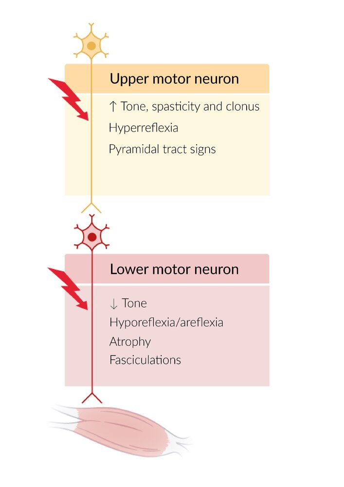 <p>Lesion between ventral horn + muscle</p><ul><li><p>Loss of excitatory firing</p></li></ul><p>Muscle atrophy + fasciculation (twitching)</p><p>Peripheral paresis: No voluntary movement +</p><ul><li><p>Decreased tone</p></li><li><p>Decreased power</p></li><li><p>Hyporeflexia/areflexia</p></li></ul><p>Overflow incontinence</p><ul><li><p>Bladder overfills = Involuntary urine leakage</p></li></ul><p>Downgoing Babinski reflex (normal)</p><ul><li><p>Toes down</p></li></ul><p></p>