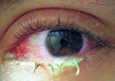 <p>What is the illness script for bacterial conjunctivitis?</p>