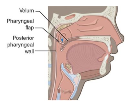 <p>Secondary palatal surgical procedure in which a muscular flap is cut from the posterior pharyngeal wall, raised, and attached to the velum</p><p>Openings on either side of the flap allow for nasal breathing, nasal drainage, and production of nasal sounds.</p><p>Helps close the VP port and reduces hypernasality.</p>