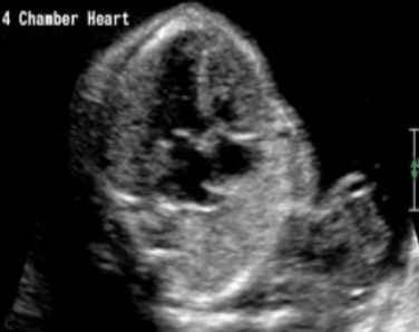 <p><span style="background-color: transparent;">Abnormally large heart (takes up more than ⅓ of fetal chest)</span></p>