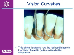 <p>It is useful for deep vertical defects for anterior segments</p>