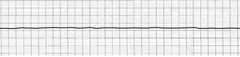 <p>1. Ventricular Fibrillation (VF)</p><p>2. Ventricular Tachycardia (VT)</p><p>3. Asystole</p><p>4. Pulseless Electrical Activity (PEA)</p>