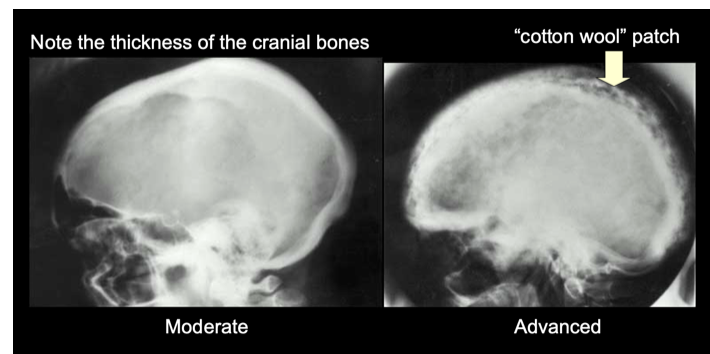 <p>A radiographic finding representing thickened, disorganized trabeculae.</p>