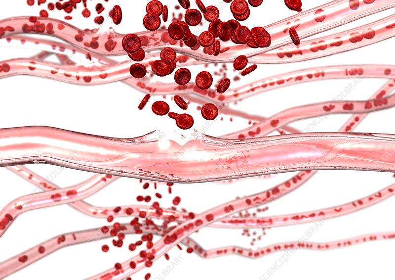 <p>capillary (tiny) <strong>burst</strong> → blood cells <strong>leak</strong> out under</p><p>spidery veins</p><p>treatment:</p><ul><li><p>resolves independently</p></li></ul><p></p>