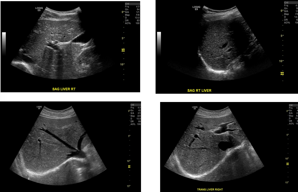 <ul><li><p>It has anterior and posterior lobes.</p></li><li><p>It is separated from the left lobe by the IVC and gallbladder.</p></li><li><p>It is divided into segments by the right hepatic vein.</p></li><li><p>It contains the right portal vein and right hepatic artery.</p></li><li><p>It is imaged using subcostal or intercostal windows.</p></li></ul><p></p>