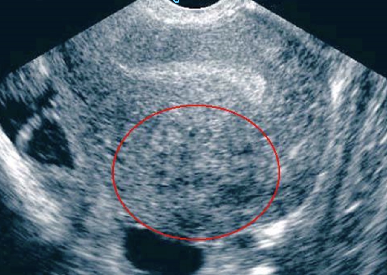 <p>Identify the pathology in the red circle.</p>