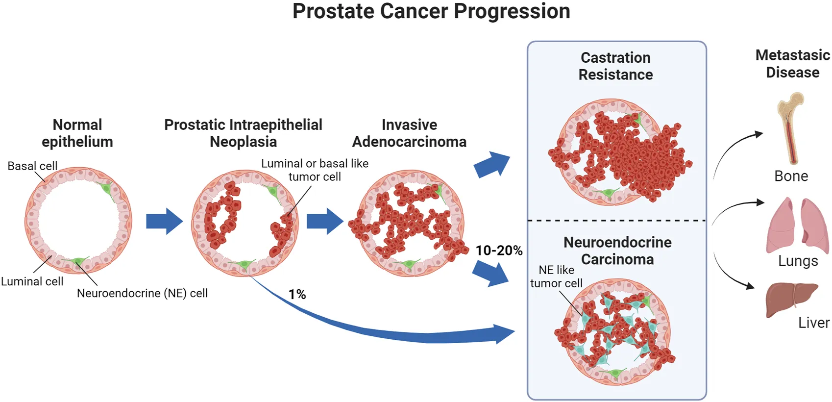 <ul><li><p>As the tumour progresses, the basement membrane begins to break down and the proliferating cells are able to break out the duct</p></li><li><p>Can metastasise to the lymph nodes before eventually metastasising to the bones</p></li></ul><p></p>