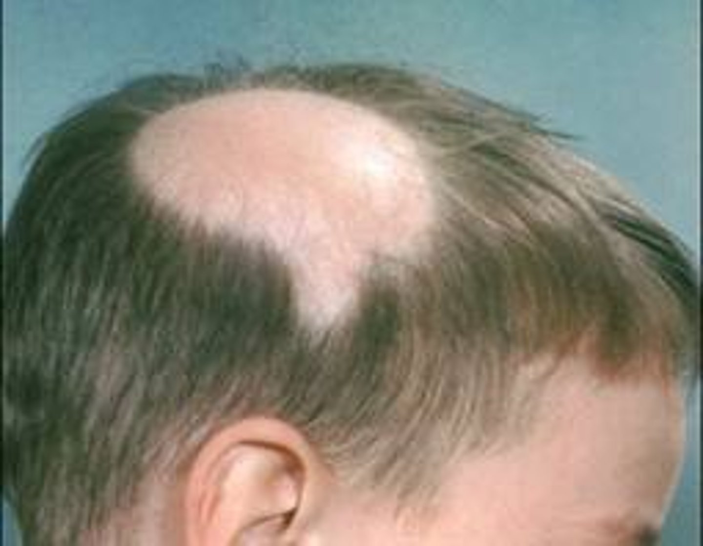 <p>-hair shedding at the root</p><p>-sudden onset of clearly demarcated, usually localized, round or oval patches of hair loss</p><p>-leaves smooth skin without hair</p><p>-no visible scaling or erythema</p>