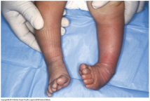 <p><span>congenital birth defect where a baby's foot is twisted inward and downward</span></p>