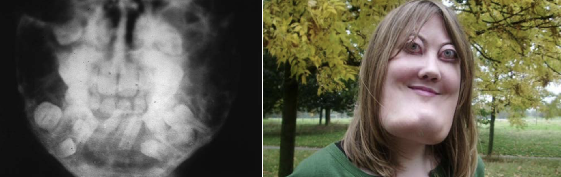 <p>What tumour like disorder is this, what specific feature can you see in the 1st image that explains why bro lookin like buzz lightyear?</p>