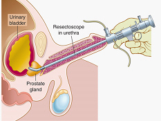 <p><span>The picture shows LEEP procedure:</span></p>