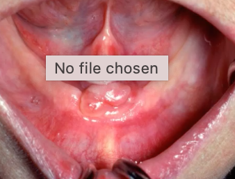 <p>reactive (hyperplastic) folds of tissue associatd with ILL-FITTING DENTURE</p>
