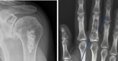 <p>What is this?</p><p>- 10-30 yo</p><p>- No pain until trauma</p><p>- Metaphyseal - Hands & feet, phalanges, metacarpals, femur/ tibia, humerus, ribs</p>