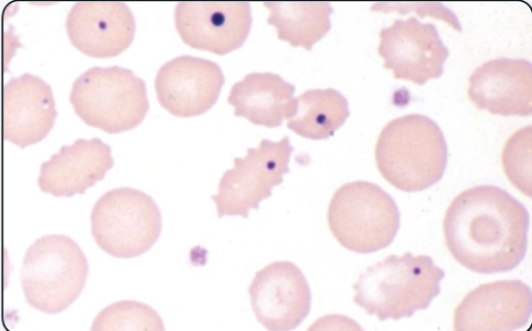 <p>What cellular inclusion is shown? What is it composed of? What anemia is it most associated with?</p>