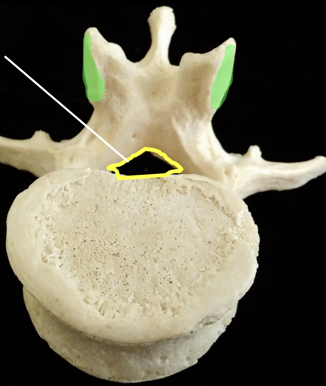 <p>From the inferior view, what is the green region highlighted on the lumbar vertebrae?</p>