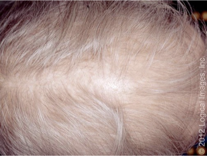 <p>What does this refer to</p><ul><li><p>Hair loss most frequently presents as hair thinning</p><ul><li><p>Frontal and crown areas of the scalp</p></li><li><p>Relative sparing of the occipital scalp </p></li></ul></li></ul><p></p>