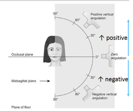 <p>Where does the cone point in + angulation</p>