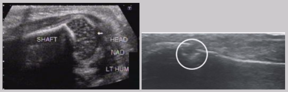<ul><li><p><span style="background-color: transparent;">Non-articular&nbsp;- sharp distinct hyperechoic line (bright reflector)</span></p></li><li><p><span style="background-color: transparent;">Articular - covered by cartilage (hypoechoic)</span></p></li><li><p><span style="background-color: transparent;">Should be smooth surface</span></p><ul><li><p>Large gap may mean a break</p></li><li><p>Small gap is likely a nutrient channel </p></li></ul></li></ul><p></p>