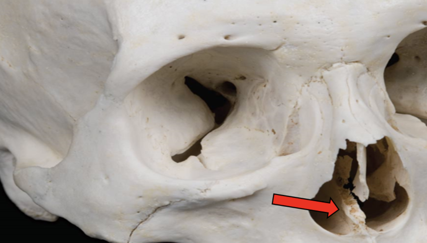 <p><span><strong>Identify the bone marking indicated by the pointer.</strong></span></p>