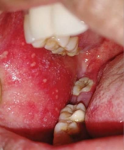 <p><span style="font-size: calc(var(--scale-factor)*12.00px);">Red spots on the oral mucosa opposite the molars</span></p>