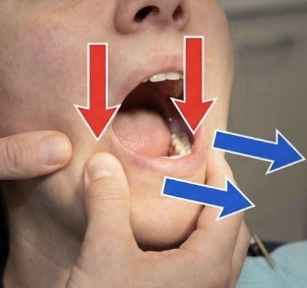 <p>Mandible locks in full opening, closure impossible </p><p>Very painful due to elevator muscle spasm </p><p>Firm continuous downward pressure on lower molars then a gentle backward push treats it </p>