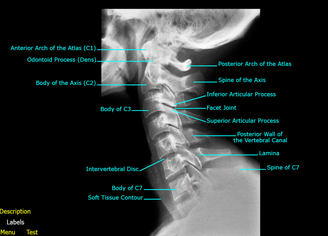 <ol><li><p> Anterior Arch of the Atlas (C1)</p></li><li><p>Odontoid Process</p></li><li><p>Body of the Axis (C2)</p></li><li><p>Body of C3</p></li></ol><p></p>