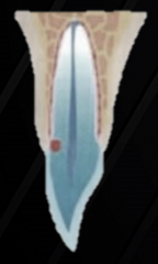 <p>supracrestal, CEJ level</p>