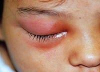 <p>structures anterior to orbital septum</p><p>treatment: Augmentin or 2nd or 3rd generation cephalosporin</p>