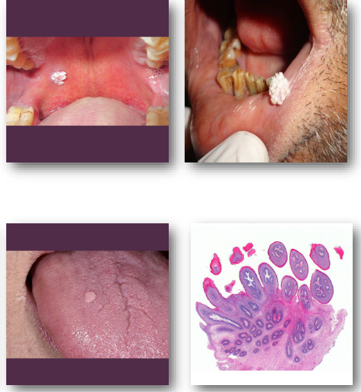 <ul><li><p><strong>Soft</strong>, painless exophytic papillary nodule</p></li></ul><p>•Surface shows <strong>classic cauliflower-like pattern (pebbly, finger-like projections)</strong></p><p>•<strong>Color varies from white to normal mucosa (excess keratin gives white appearance)</strong></p><p>•<strong>Typically solitary and less than 0.5 cm</strong></p><p>•Common on <strong>palate, tongue, and lips- particularly areas subject to minor trauma</strong></p>