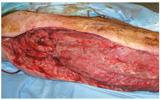 <p>“Flesh eating” disease ; pyrogenic toxin produced by S. pyogenes acts as superantigen</p>