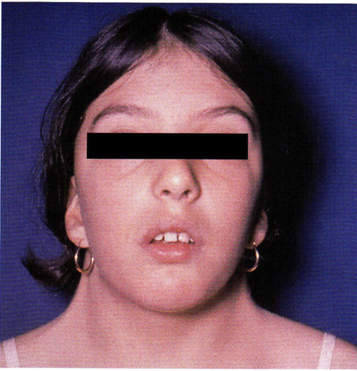 <p>-webbing of the neck</p><p>-caused by patient has only one X chromosome or monosomy X</p>