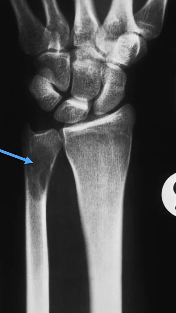 <p>What tumour-like condition is this, what bone is it in and what can be seen?</p>